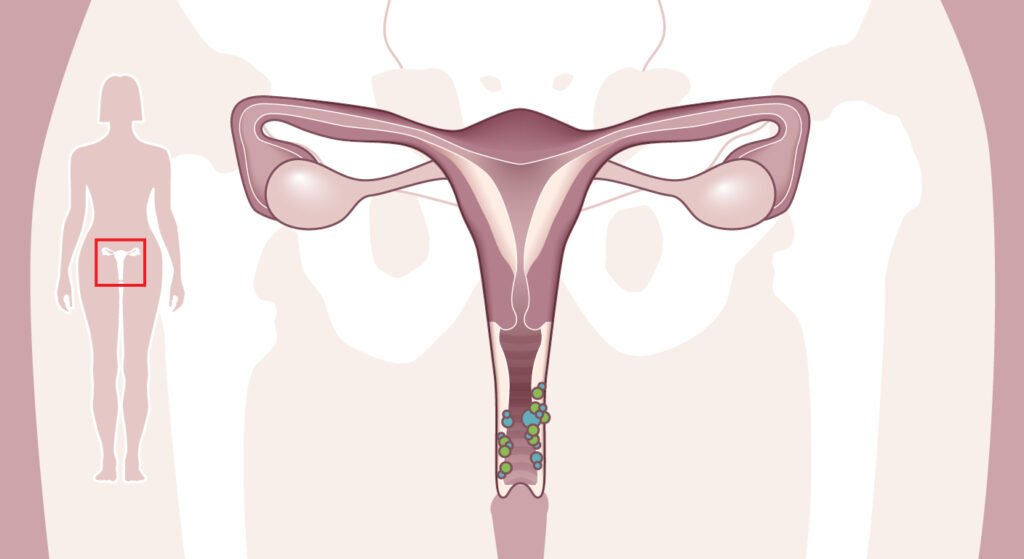 Cáncer de Vagina