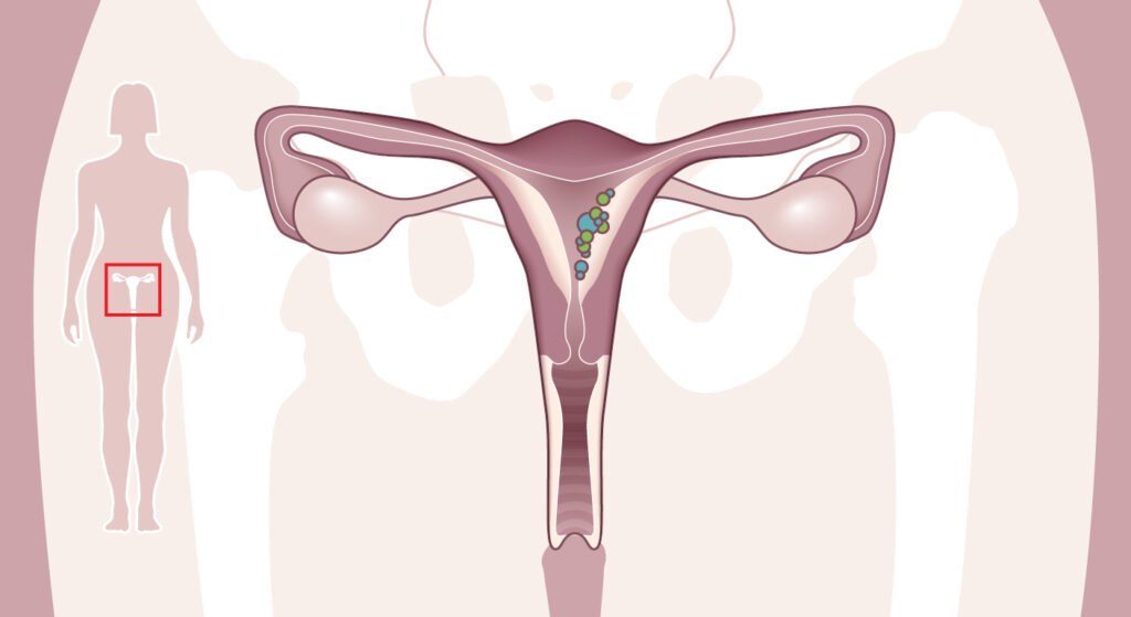 Cáncer de Endometrio