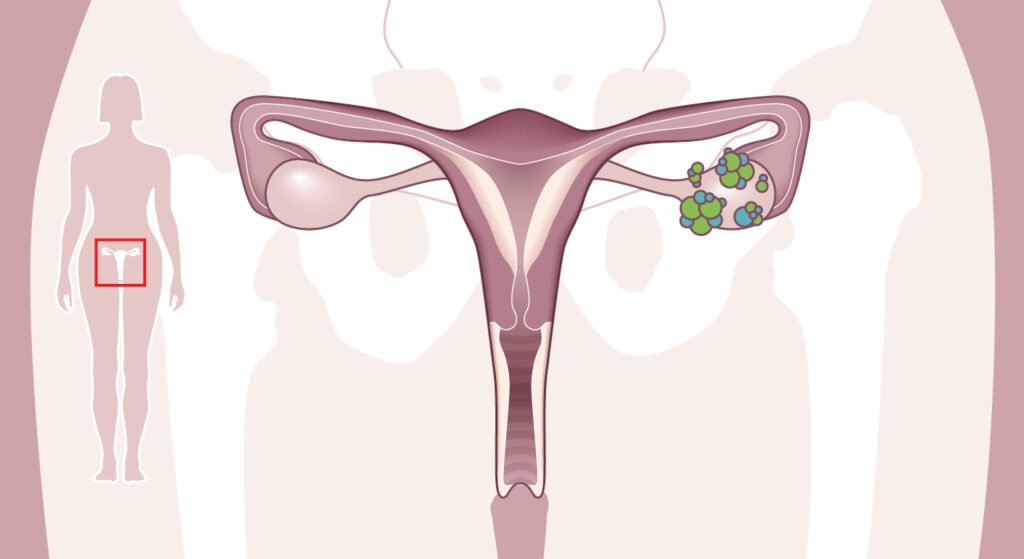 Cáncer de Ovario