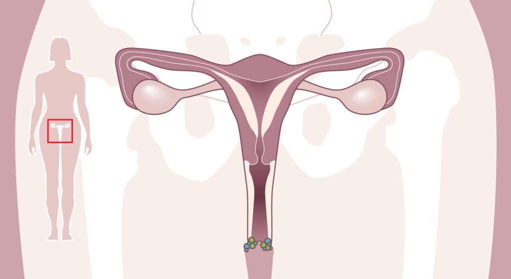 Cáncer de Vulva