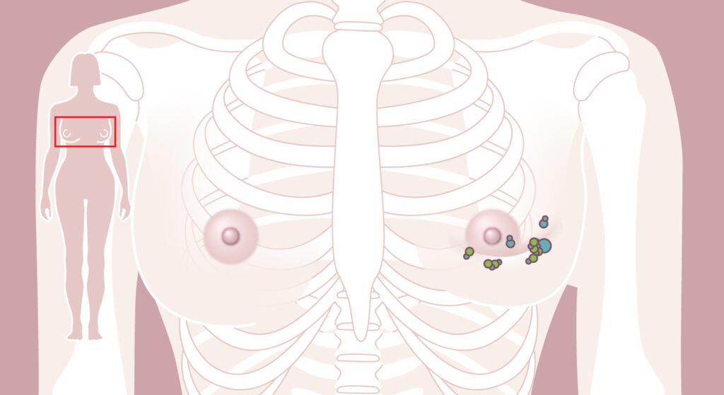 Cáncer de mama